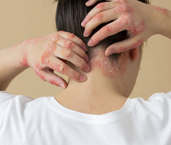 Understanding Skin Conditions & Our Role in Care blog itchy
