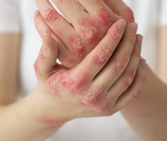 Seborrheic Dermatitis: Beyond Flakes – A Comprehensive Overview blog sd